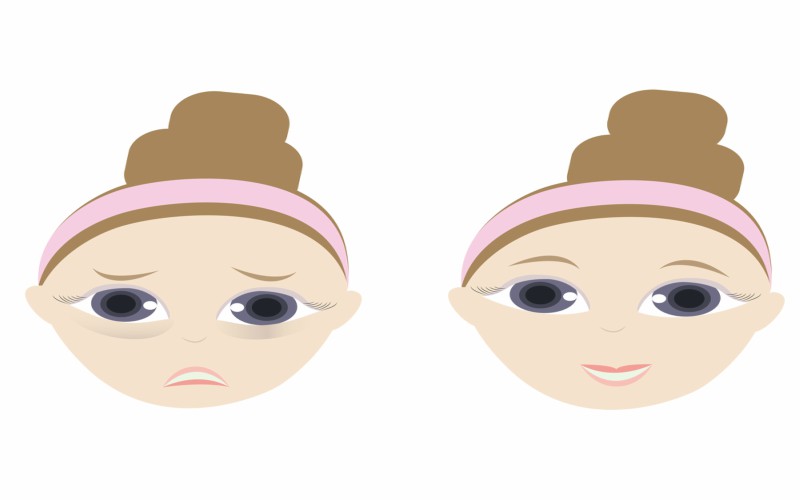 Baggy Eyes